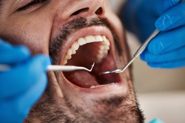 Best Emergency Wisdom Teeth Removal in Roeland Park, KS